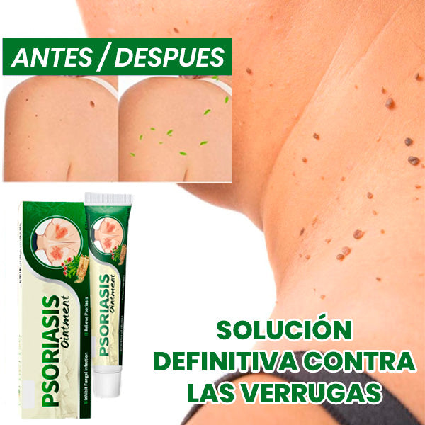 Crema Quita Verrugas Rápido y Sin Dolor | Tratamiento en Casa + REGALO