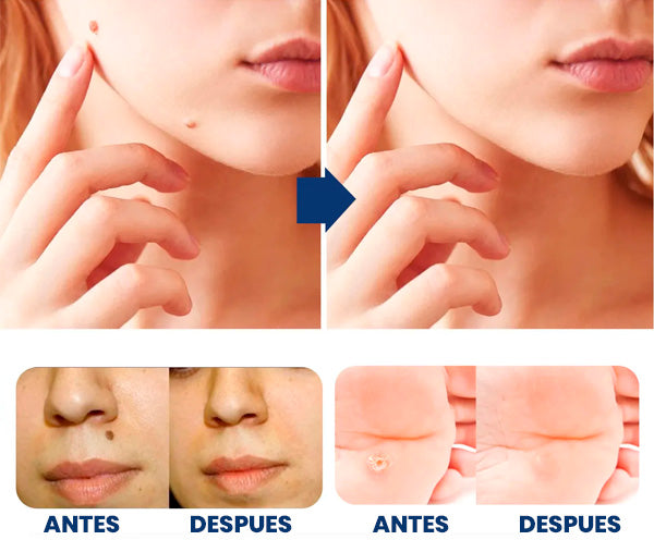 Crema Quita Verrugas Rápido y Sin Dolor | Tratamiento en Casa + REGALO