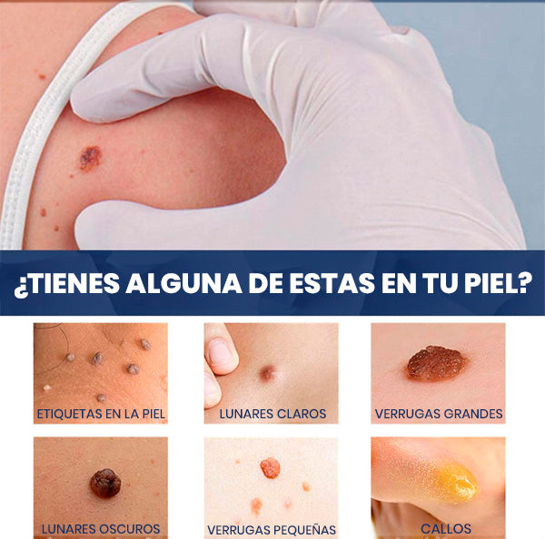 Crema Quita Verrugas Rápido y Sin Dolor | Tratamiento en Casa + REGALO