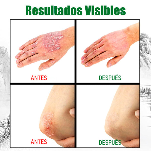 Crema Antifúngica y Antipicazón Jinyue – Tratamiento Natural para Tiña, Hongos y Psoriasis | 20g