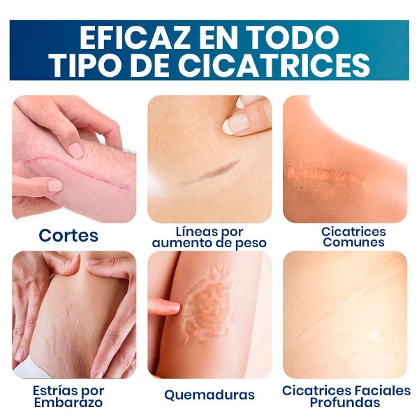 GEL DE SILICONA PARA CICATRICES ESTRÍAS QUELOIDES QUEMADURAS