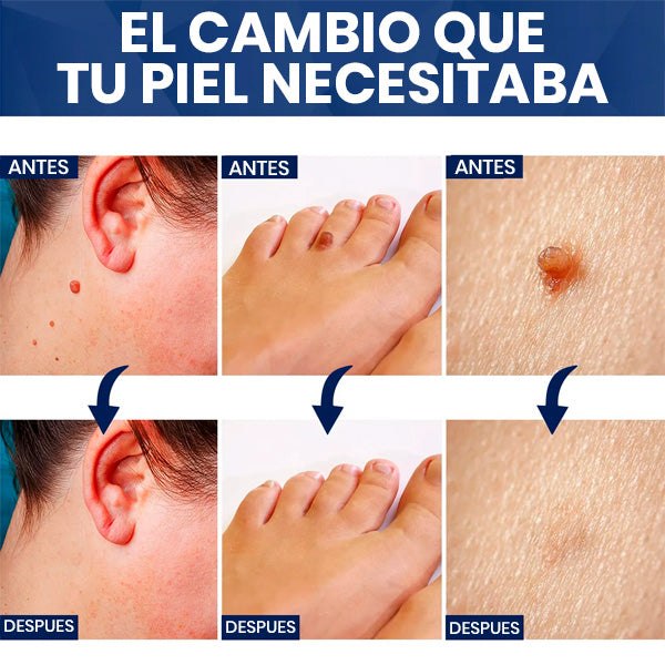 Crema Quita Verrugas Rápido y Sin Dolor | Tratamiento en Casa + REGALO