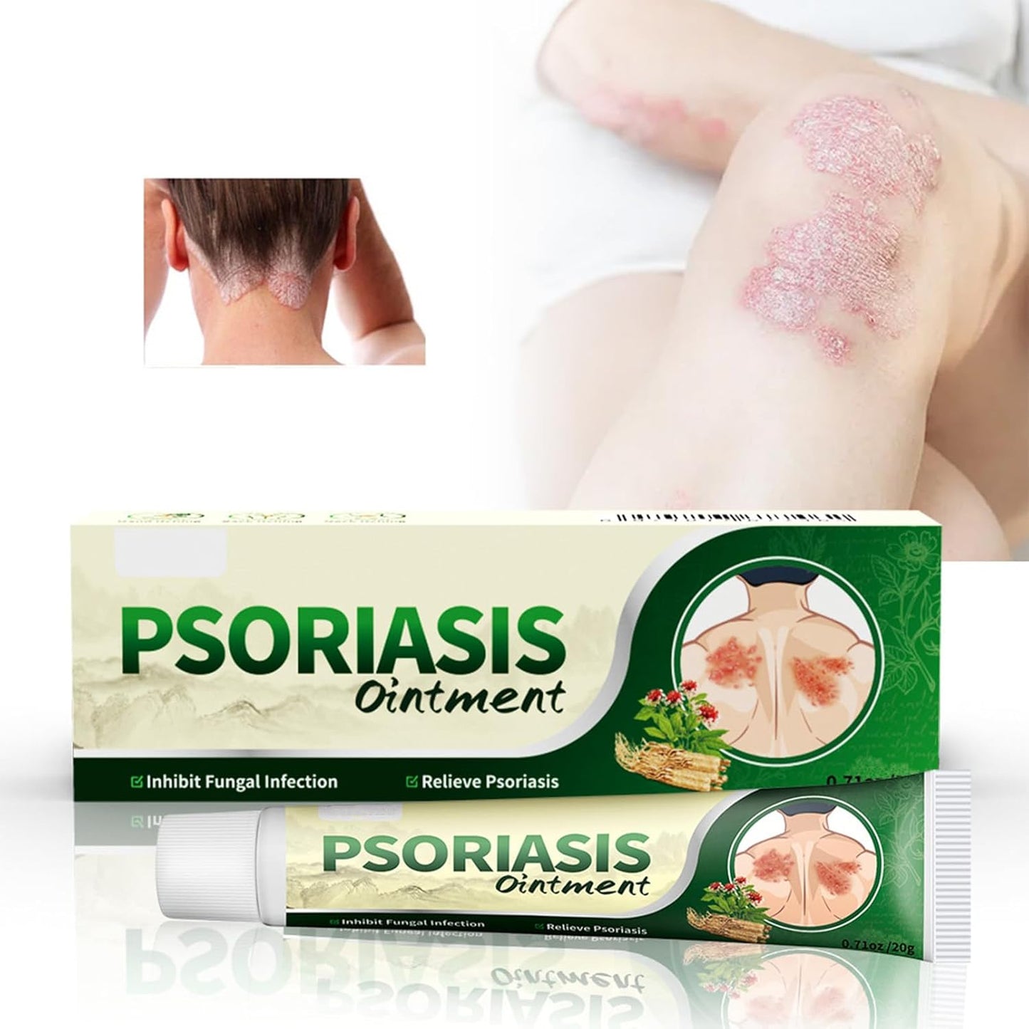 Crema Antifúngica y Antipicazón Jinyue – Tratamiento Natural para Tiña, Hongos y Psoriasis | 20g