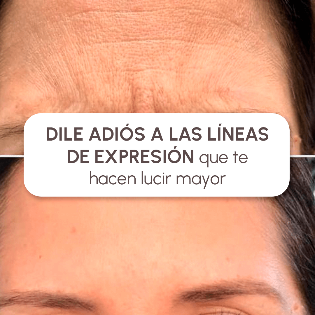 Parches Antiarrugas con COLAGENO HIDROLIZADO + Envío GRATIS