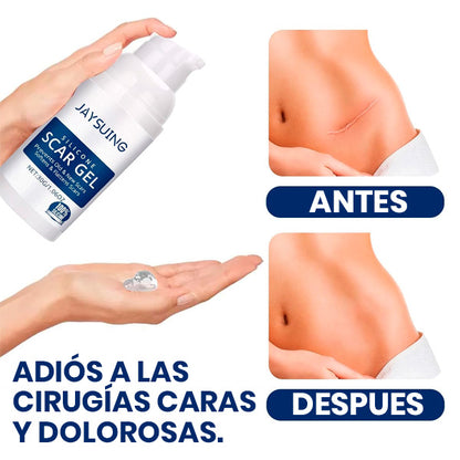 GEL DE SILICONA PARA CICATRICES ESTRÍAS QUELOIDES QUEMADURAS