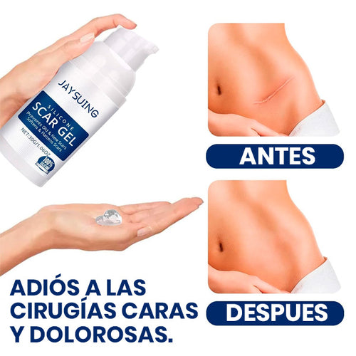 GEL DE SILICONA PARA CICATRICES ESTRÍAS QUELOIDES QUEMADURAS