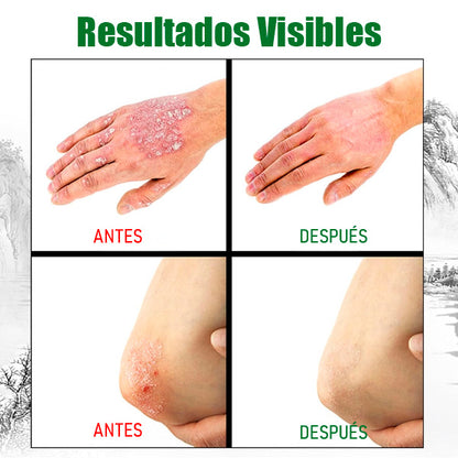 Crema Antifúngica y Antipicazón Jinyue – Tratamiento Natural para Tiña, Hongos y Psoriasis | 20g