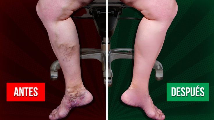 VEINS– Gel Alivio Venas y Várices 20g