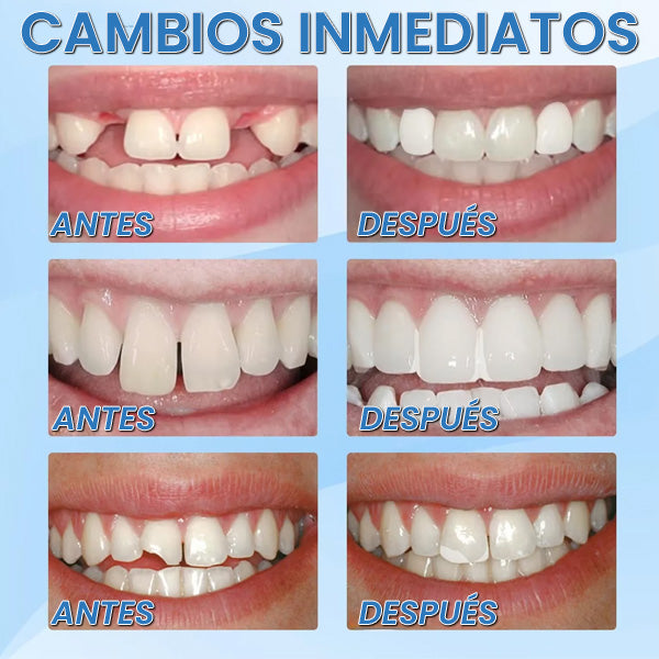 Solución temporal para dientes perdidos